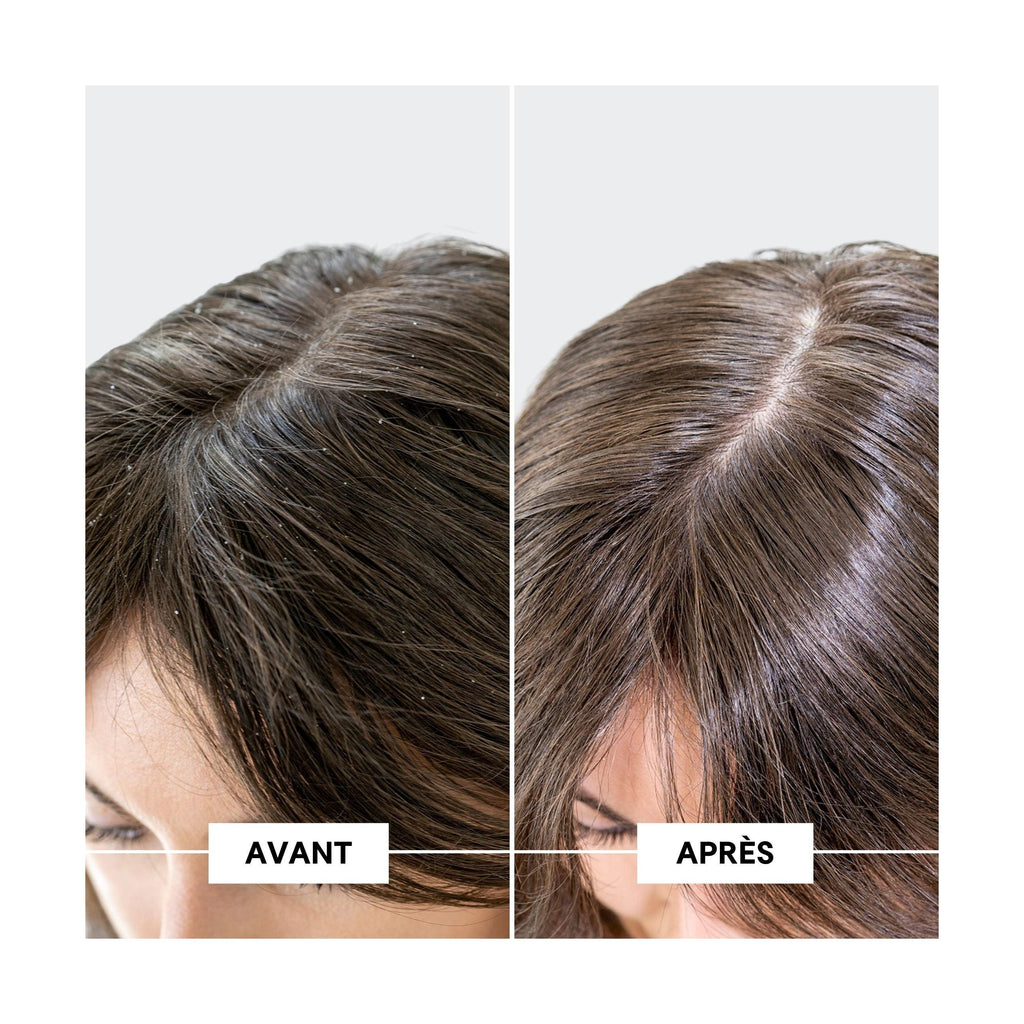 Oily Dandruff & DS Protocol