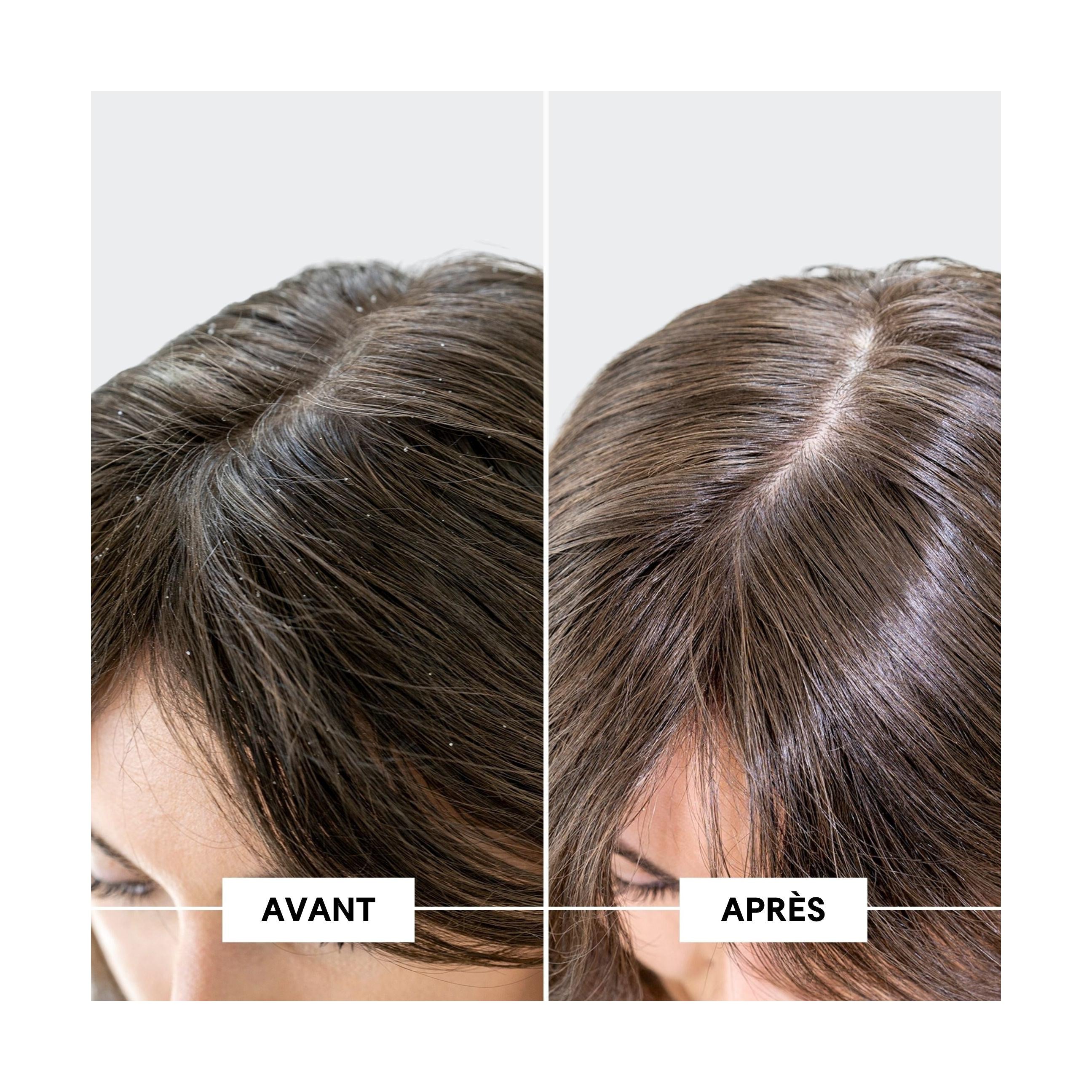 Oily Dandruff & DS Protocol
