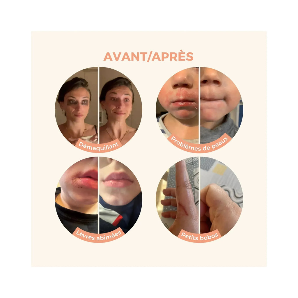 Avant/Après Baume Magique Avis Client Démaquillant Eczéma