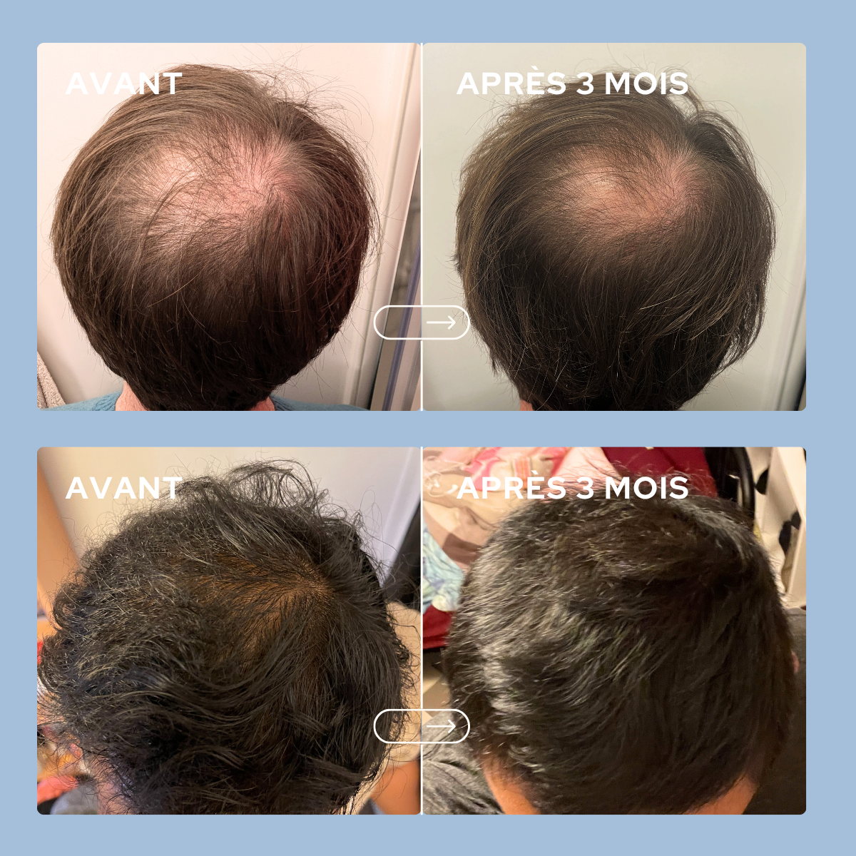 Cure Anti-Chute De Cheveux Hommes