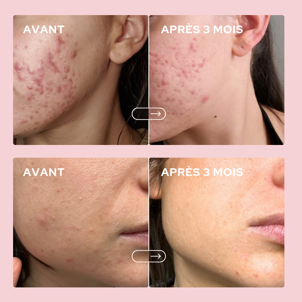 Anti-Blemish Gummies