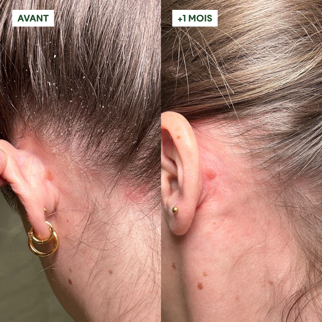 Exfoliante Activo Anticaspa
