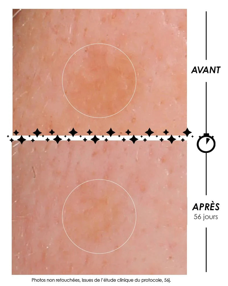 Comparative before/after macroscopic photographs of L'Eclair de lune La Foudroyante: reduction in the intensity of a pigmented spot on the skin after 56 days of Garancia clinical protocol. Unretouched photos.